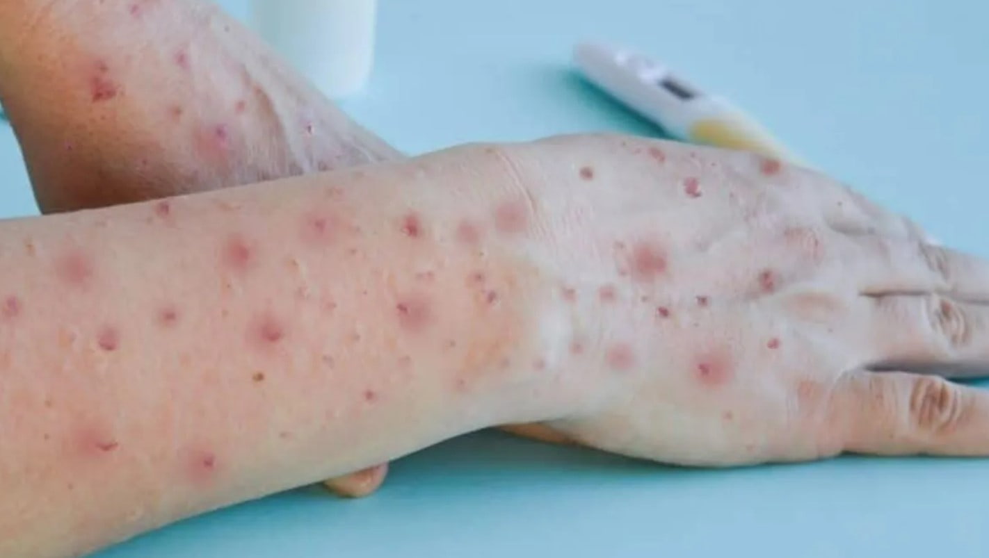 Varíola dos macacos causa erupções na pele – Foto: internet / reprodução